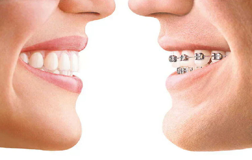 Are Clear Aligners More Expensive Than Braces? Are Clear Aligners More Expensive Than Braces?