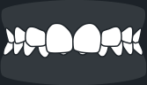 Overbite
